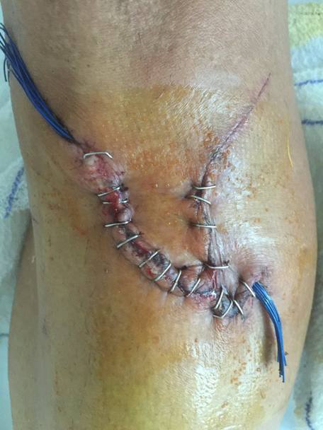 Il ginocchio di Francisco Ventoso con i punti dopo l&#39;incidente. Facebook